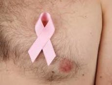 Male Breast Cancer